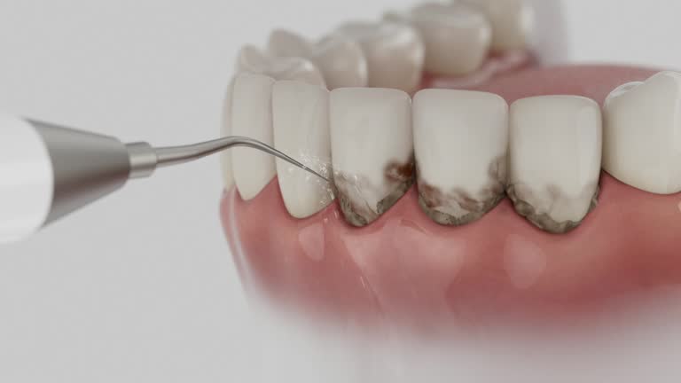 Trusted Wisdom Tooth Removal service in Pembroke Park, FL - Dentist Open Now